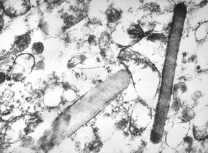 F,39y. | metastatic alveolar sarcoma of soft parts